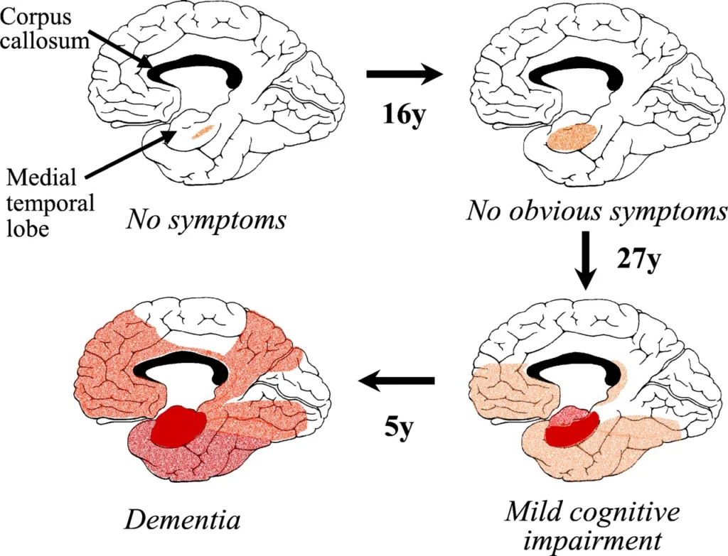 reasons-for-memory-loss